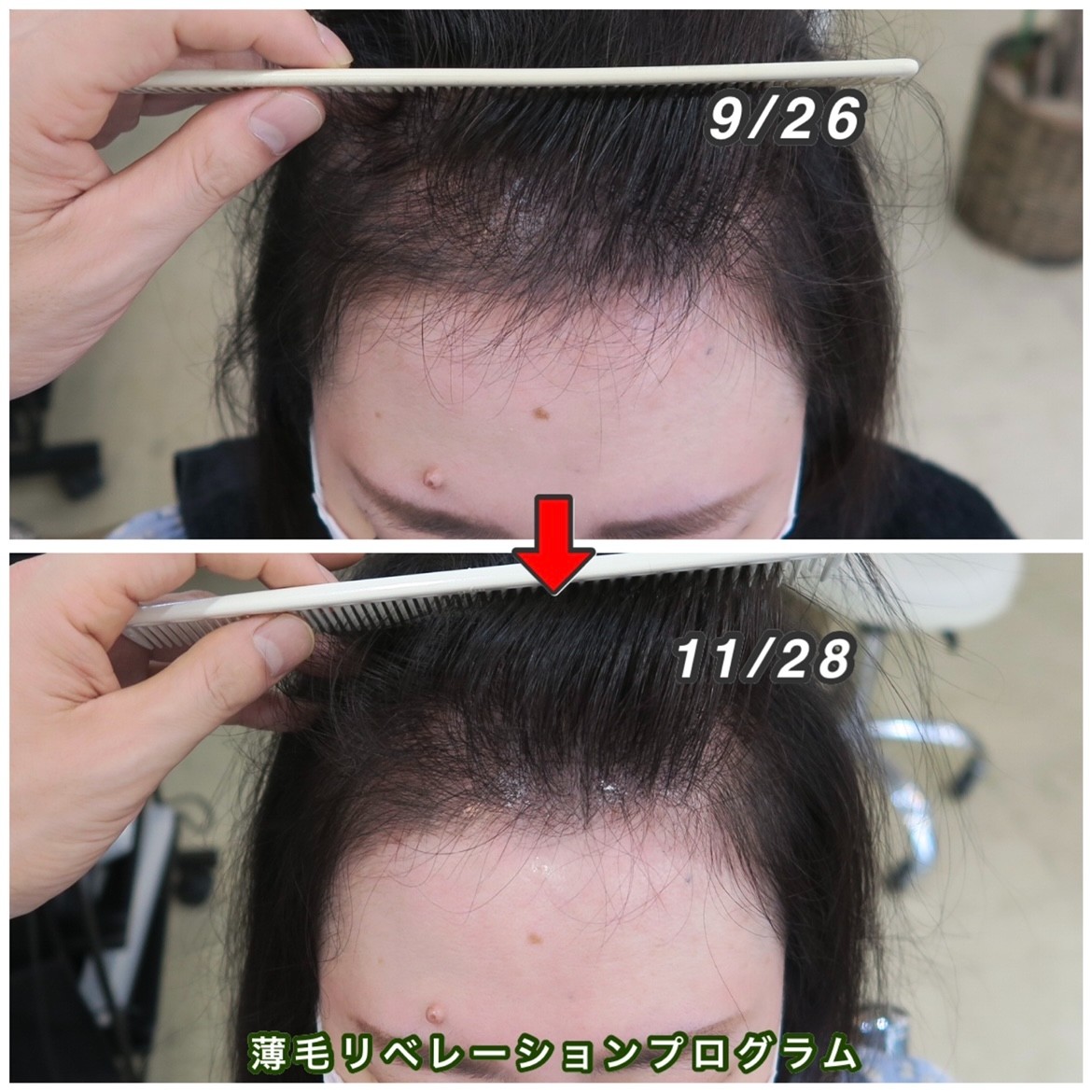 薄毛改善をするために312kmかけて愛知県から通っていただいてます。