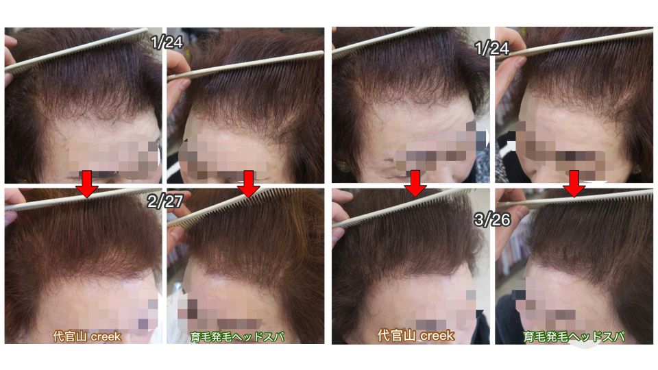 【衝撃】70代女性の薄毛が治る？20年悩んだ女性が４ヶ月で改善した秘密