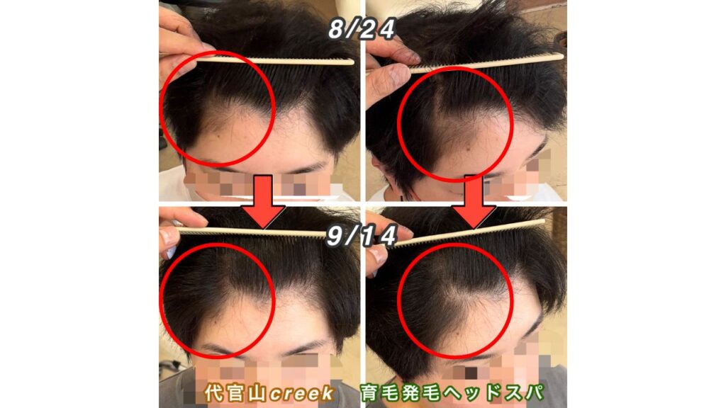 東京都中目黒在住、30代女性のNさまの頭皮画像で薄毛の改善が確認できました