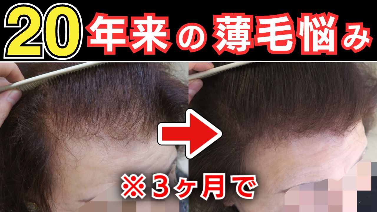 【衝撃】70代女性の薄毛が治る？20年悩んだ女性が4ヶ月で改善した秘密