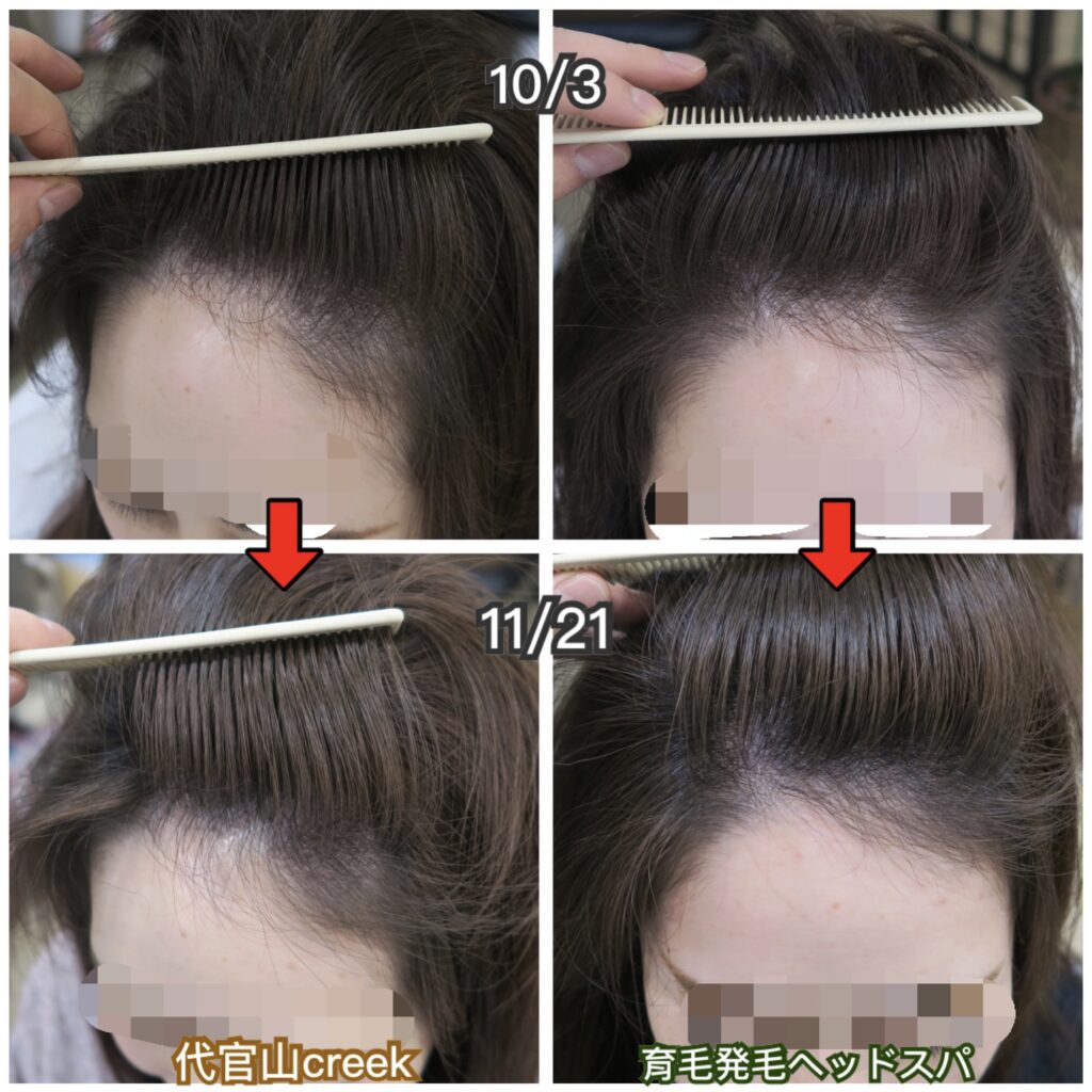 神奈川県横浜市綱島在住30代女性の薄毛改善事例と、aga治療による副作用とは？