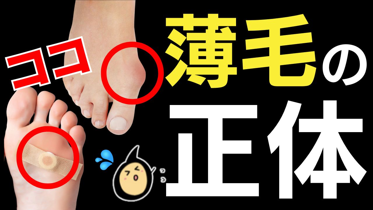 【薄毛の原因は足裏!?】女性の薄毛リスクを外反母趾と魚の目が高める根拠