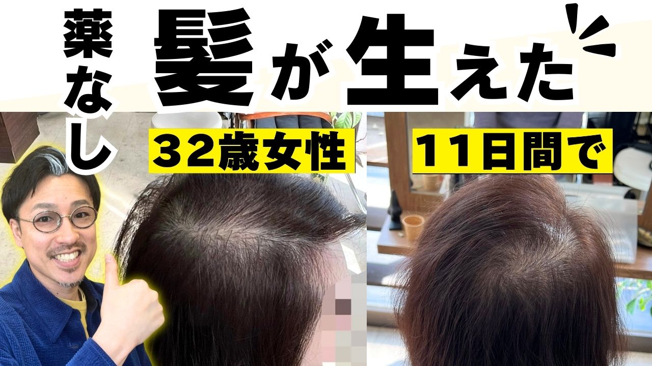 【11日で薄毛改善!?】30代女性の抜け毛がひどい時の対策3選
