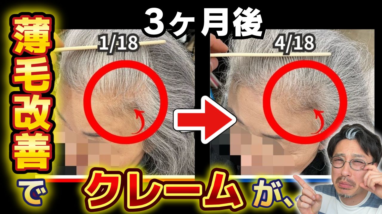 【育毛インタビュー】横浜市在住60代女性がミノキシジルをやめて薄毛改善して悩んだこと