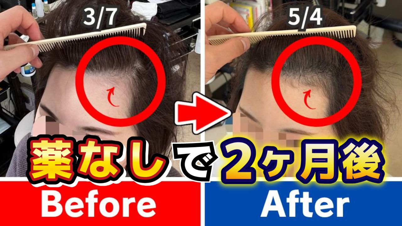 千葉県30代女性のご感想「AGAクリニックの治療よりも薄毛改善効果があります！」