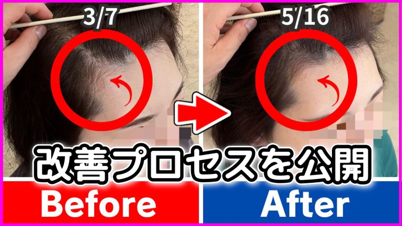 30代女性の薄毛は治る